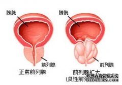 天津静海男科专家：这四种病因最易患上前列腺增生