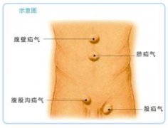 详解疝气病症