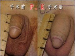 阴茎延长术后需要做那些护理工作