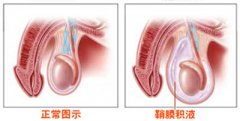 睾丸鞘膜积液的危害是什么