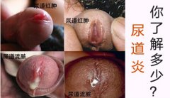 男性尿道炎新疗法——GPH-2基因递进双联疗法